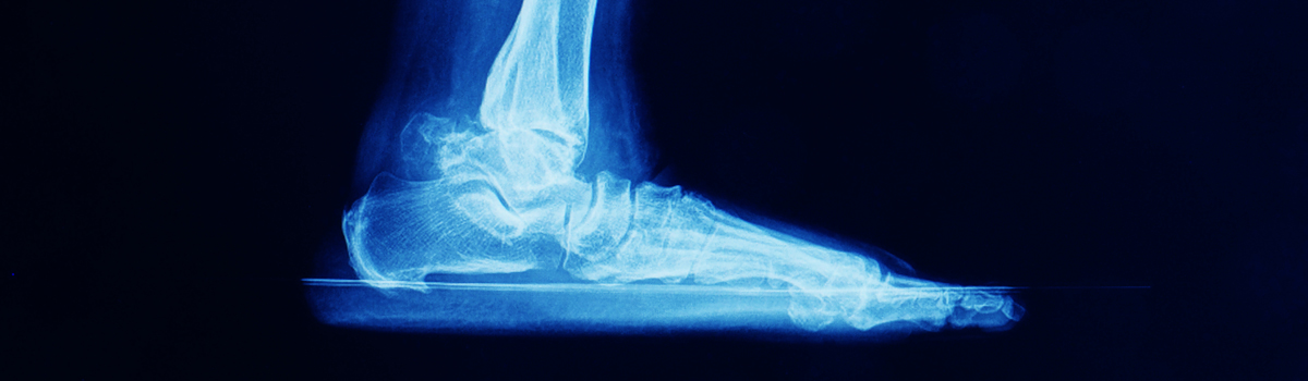 Ankle Arthritis | FASO Ankle Arthritis | FASO