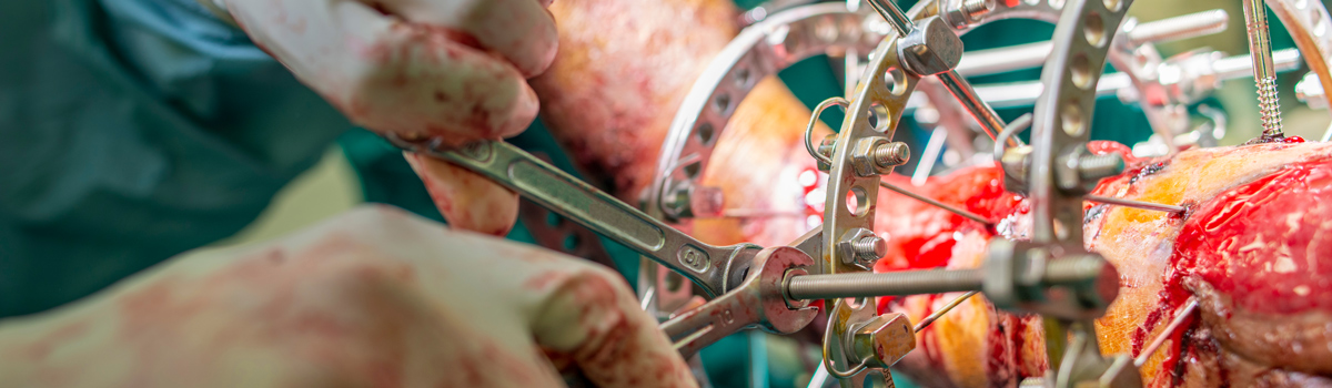 Ankle Revision Surgery | FASO Ankle Revision Surgery | FASO