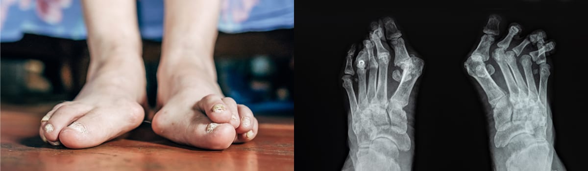 Bunions Hammertoes | FASO Bunions Hammertoes | FASO