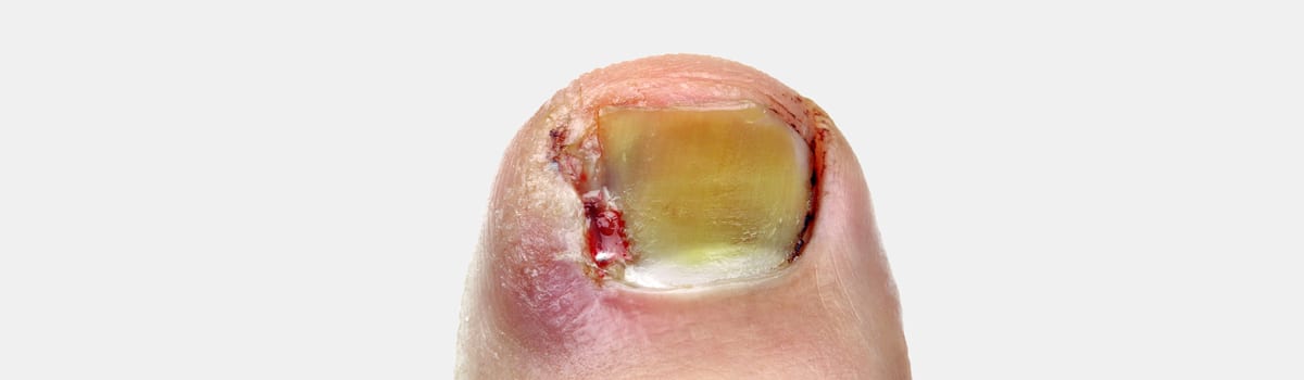 Ingrown Toenails | FASO Ingrown Toenails | FASO
