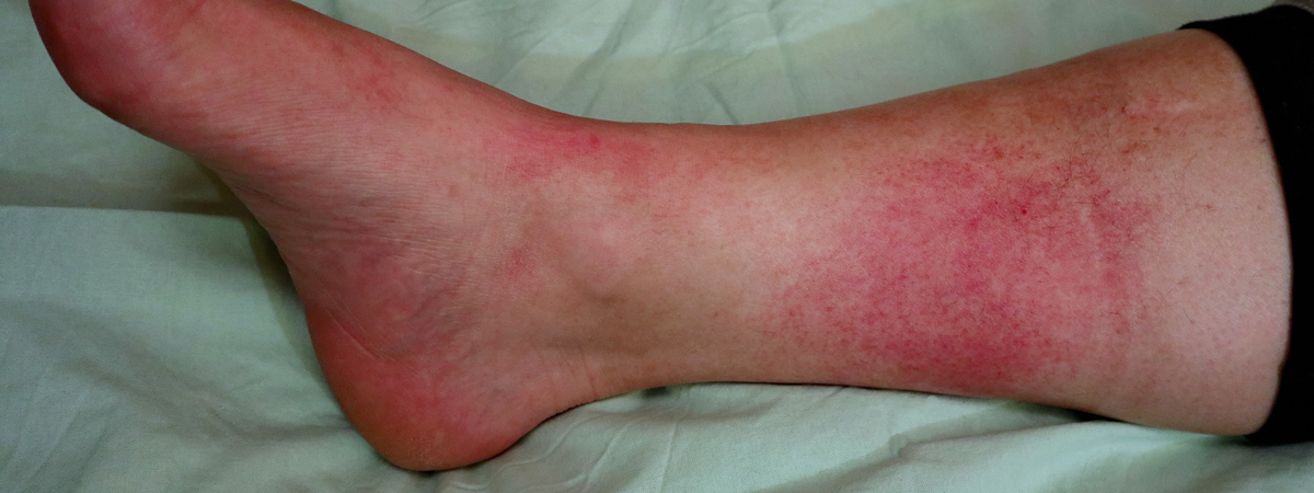 Lower Extremity Infection | FASO Lower Extremity Infection | FASO