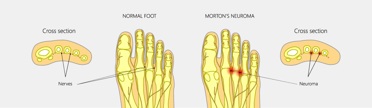 Morton's Neuroma | FASO Morton's Neuroma | FASO