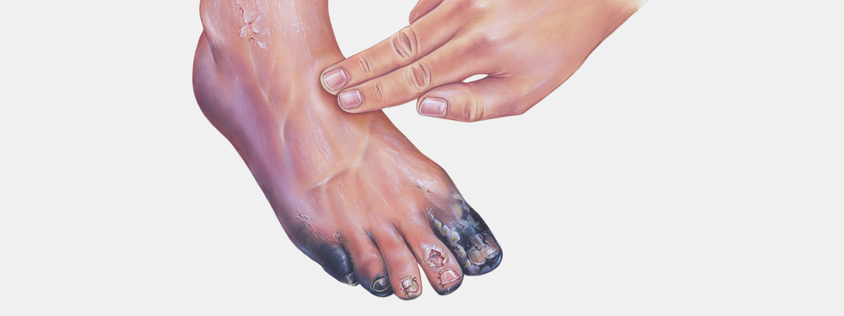 Peripheral Arterial Disease | FASO Peripheral Arterial Disease | FASO