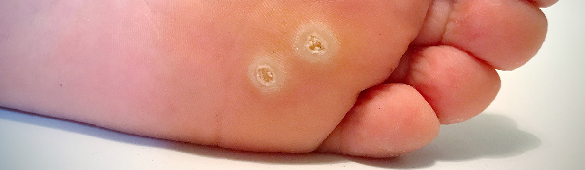 Plantar Wart | FASO Plantar Wart | FASO