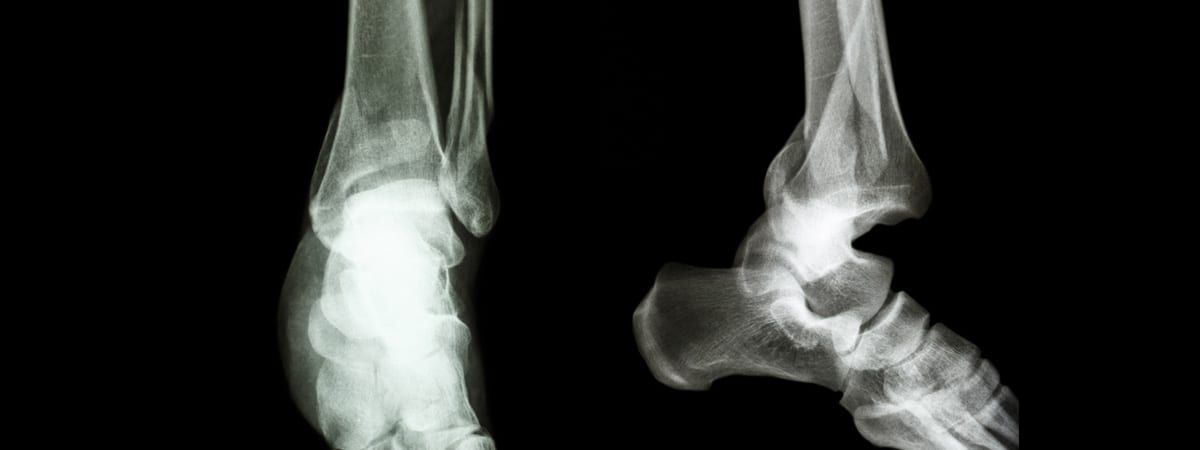 Ankle Fractures | FASO Ankle Fractures | FASO