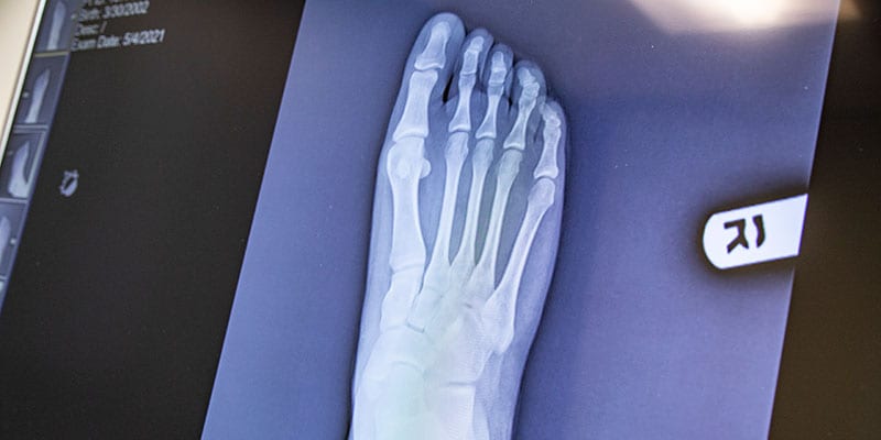 Foot-X-Ray-Narrow