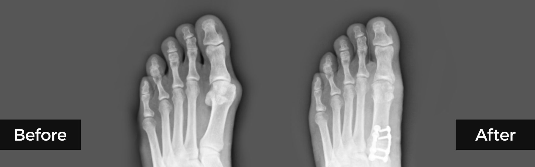 Before and After Lapiplasty Bunion Treatment