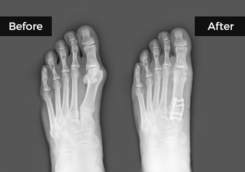 Example of Lapiplasty Treatment
