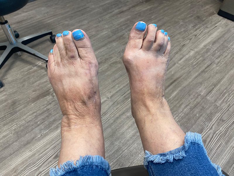 Bunion and Hammertoe Treatment | Foot and Ankle Surgeons of Oklahoma Bunion and Hammertoe Treatment | Foot and Ankle Surgeons of Oklahoma
