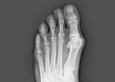 Can You Shrink a Bunion Naturally? What Works, What Does Not, and When Surgery Becomes the Answer