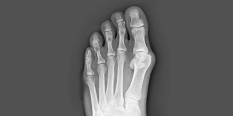 Can You Shrink a Bunion Naturally? What Works, What Does Not, and When Surgery Becomes the Answer