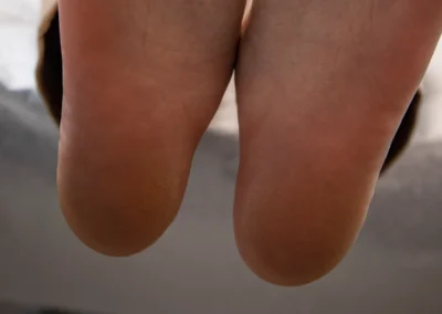 Why Won’t My Plantar Fasciitis Go Away? Three Reasons, and What to Do About Each 